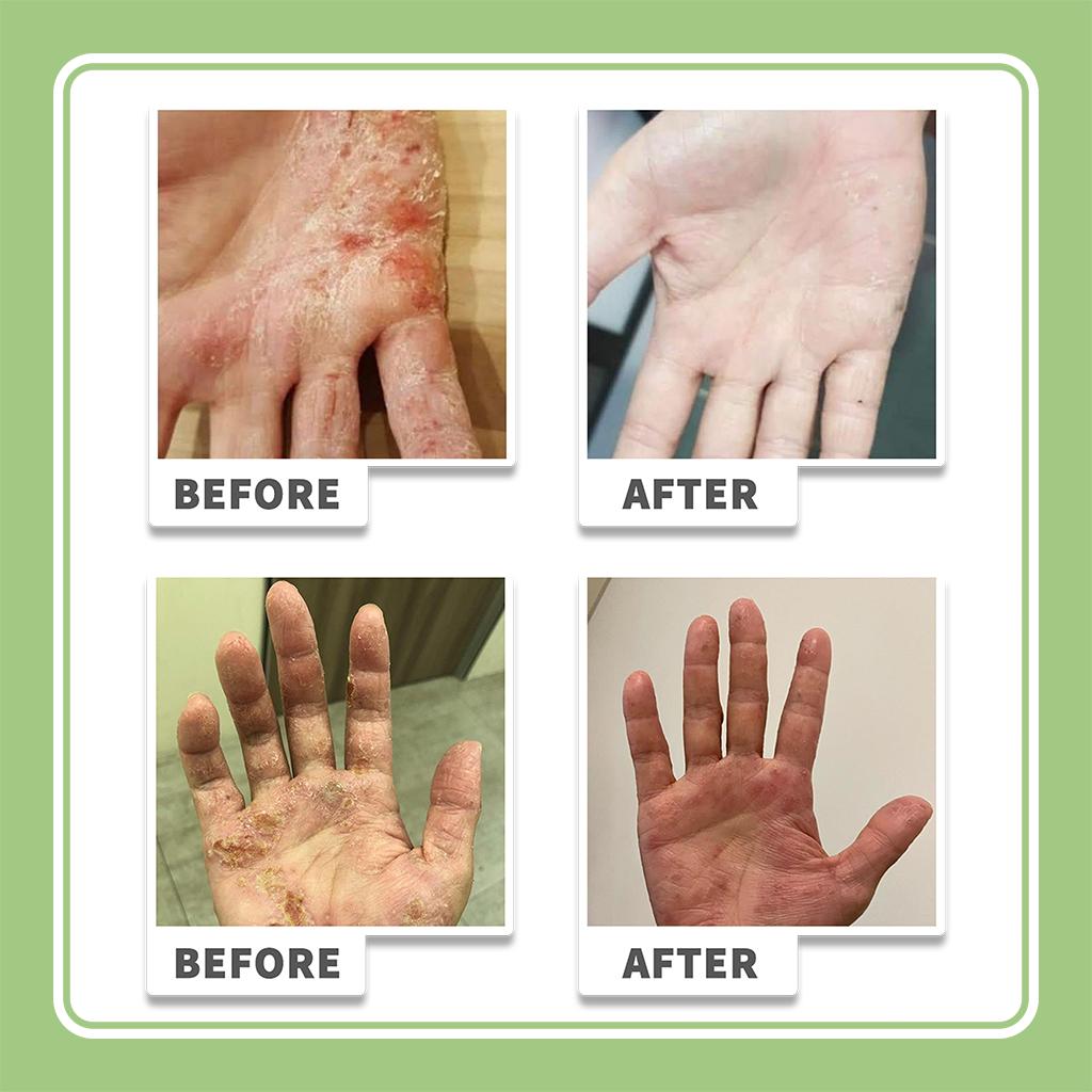 Eczema Cream